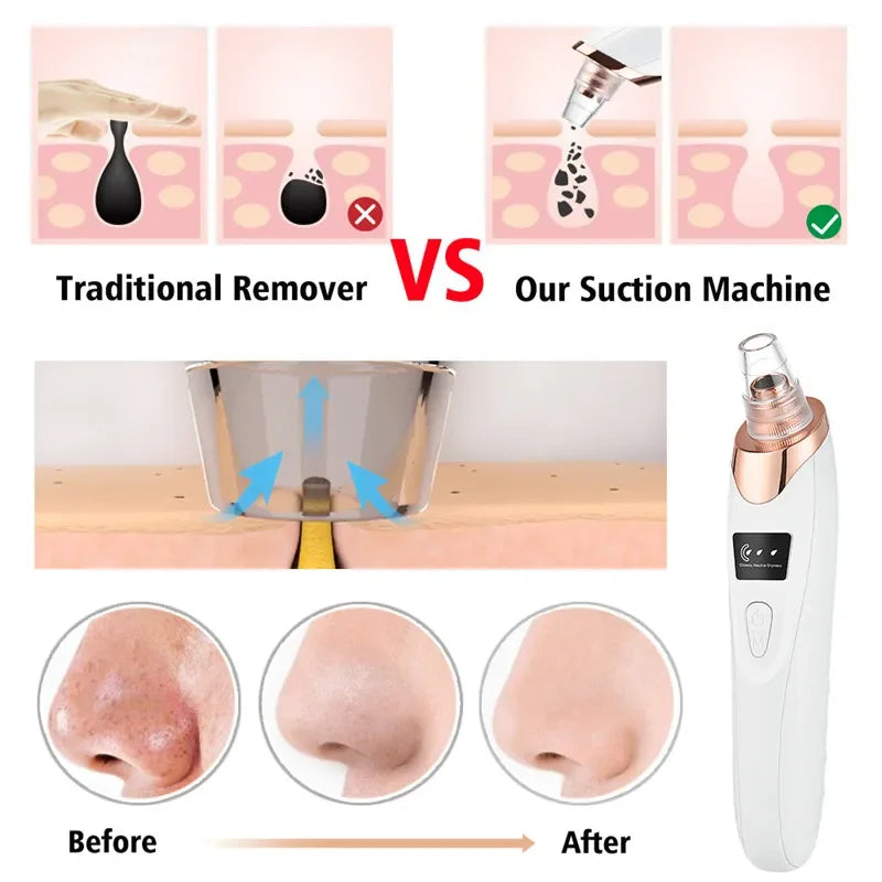 Blackhead Remover Vacuum Suction USB Rechargeable Facial Pore Cleaner Comedone Spot Acne Pimple Black Head Extractor Care Tools (Copy)